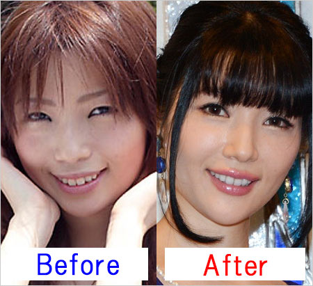 森下悠里の顔整形前後のビフォーアフター画像