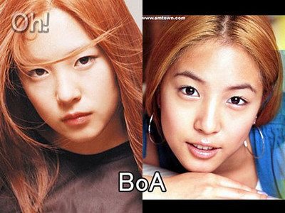 BoA整形ビフォーアフター写真