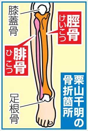 栗山千明が骨折した箇所の図