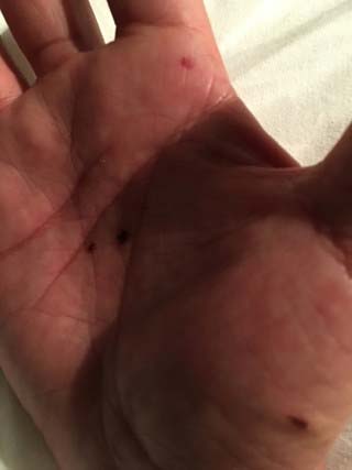 灰皿を割って負傷した手のひらの写真