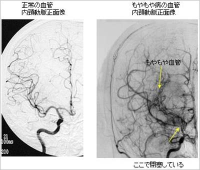 もやもや病発症時の脳血管の状態を撮影した写真