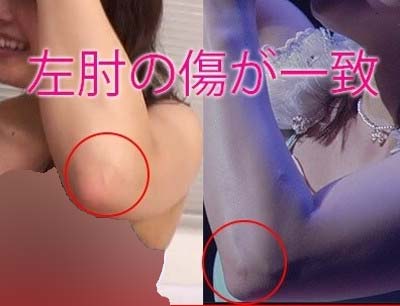 新田恵海とアダルト作品出演女性の肘の傷跡比較