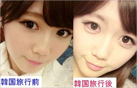 宮崎美穂が涙袋を整形する前と整形後