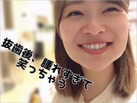 指原莉乃、親知らず抜歯後の顔写真2枚目