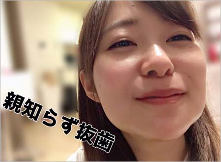 指原莉乃、親知らず抜歯後の顔写真1枚目