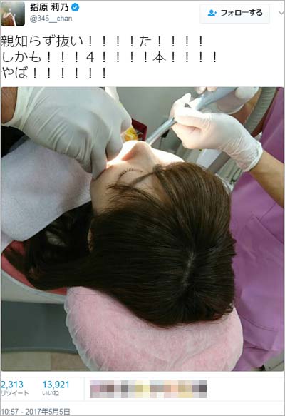 親知らずを抜歯中の指原莉乃