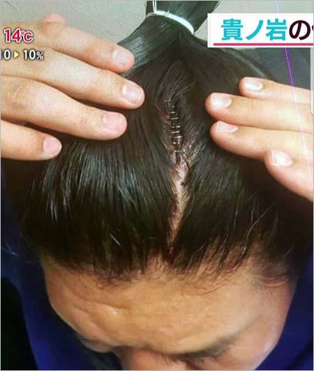 貴ノ岩関の傷痕