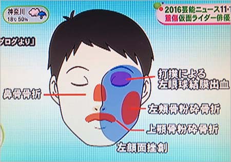 椿隆之の顔面負傷部位