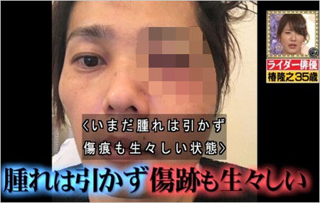 椿隆之が緊急手術直後のモザイクあり画像