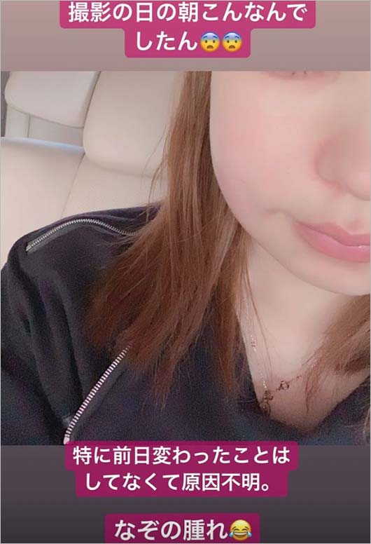 益若つばさインスタグラムストーリーズの顔が腫れている画像