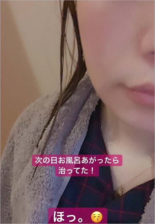 益若つばさがインスタグラムストーリーズで公開の腫れが治った後の画像