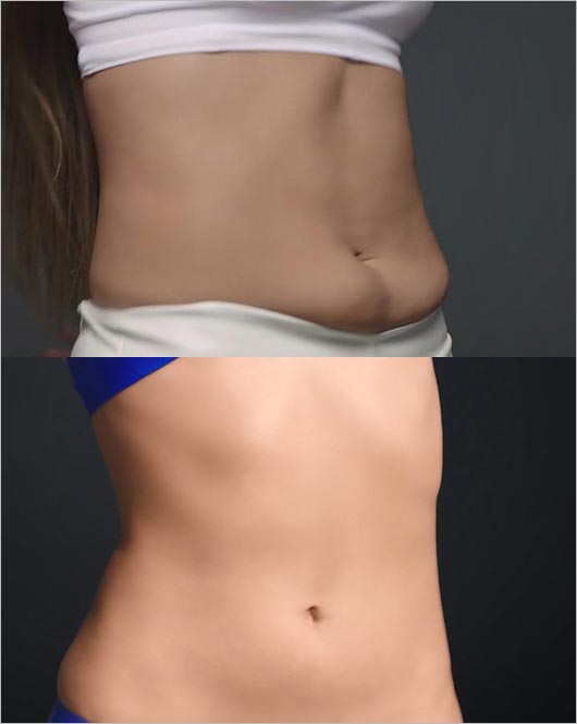 MAX・LINAライザップで痩せる前と痩せた後のお腹周りビフォーアフター画像