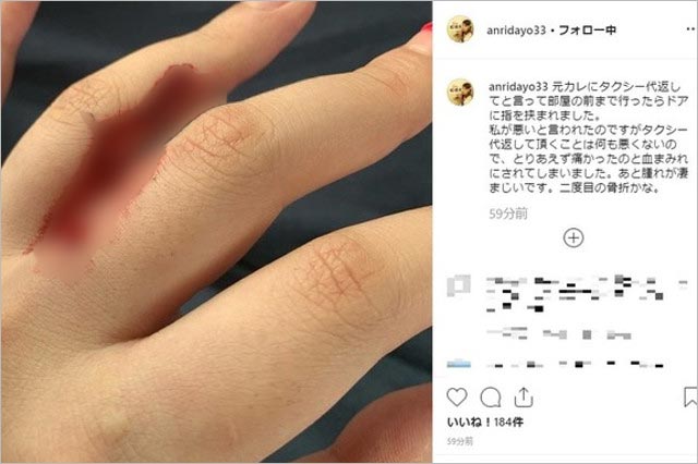 坂口杏里の手ケガ画像