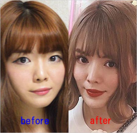妹尾ユウカ整形前・整形後のビフォーアフター画像