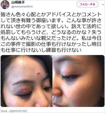 美人格闘家・山崎桃子選手が暴行被害、負傷した目の状態を報告ツイート