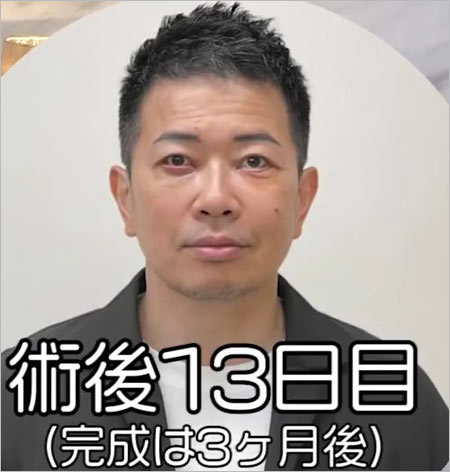 宮迫博之のクマ取り・ほうれい線除去手術後の顔画像