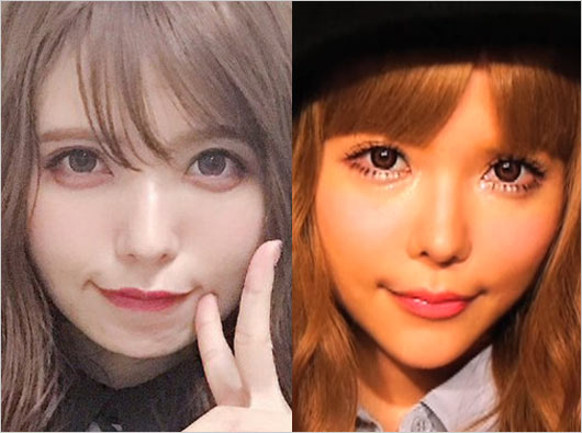 益若つばさアゴにヒアルロン酸注入前後の画像