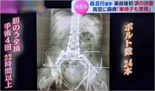 森且行がケガで手術後のレントゲン画像