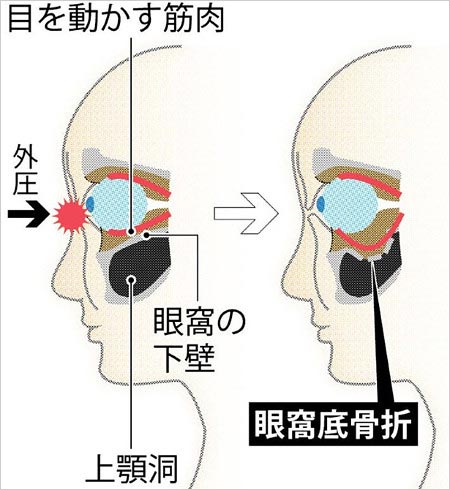 眼窩底骨折のイメージ画像