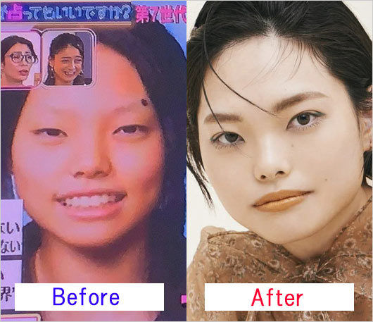 ぼる塾はるか二重・ほくろ除去手術のビフォー・アフター画像