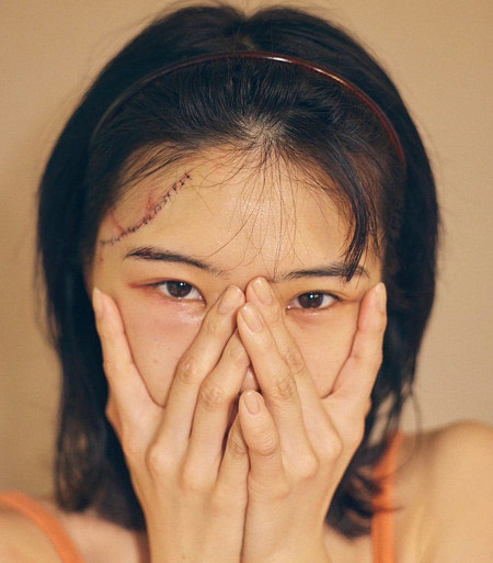 BiSHアイナ・ジ・エンドが頭部負傷、ケガ手術後の画像