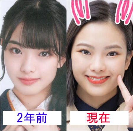 遠藤光莉が活動休止前後の顔の変化ビフォーアフター画像