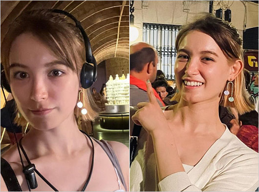 トラウデン直美がアナフィラキシー反応から回復後の顔画像