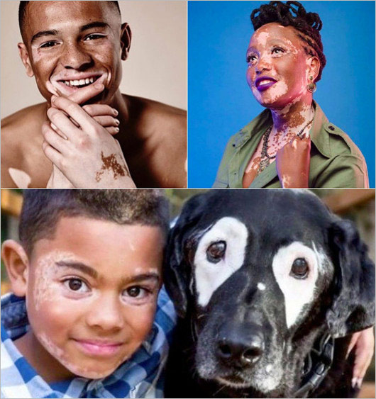 尋常性白斑患者のイメージ画像