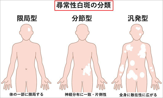 尋常性白斑の分類