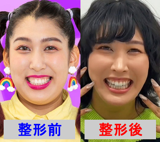 3時のヒロインゆめっちが整形前後のビフォーアフター画像