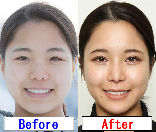 高梨沙羅選手の整形疑惑検証ビフォー・アフター画像