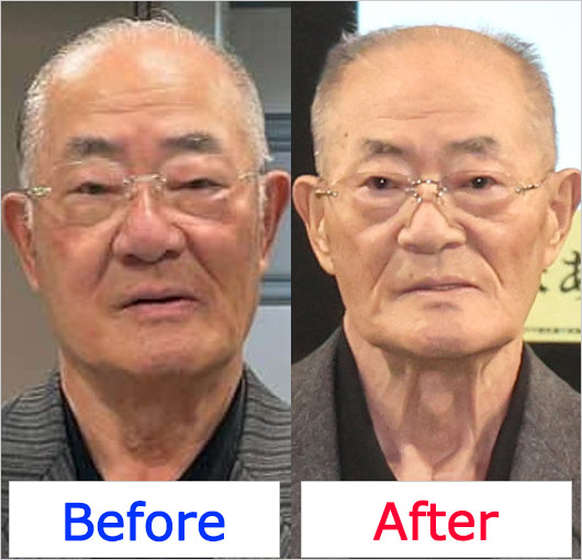 張本勲がサンモニ降板前と激ヤセした現在の顔比較画像