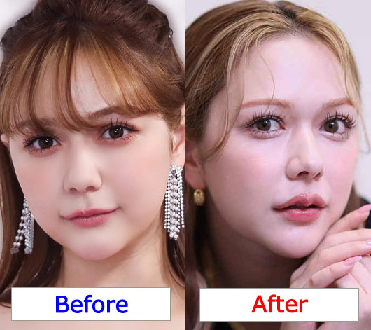 元HKT48村重杏奈の唇整形疑惑、ヒアルロン酸注入前後の顔比較画像