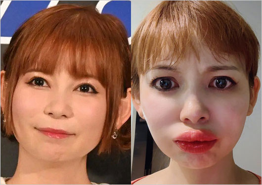 中川翔子がアナフィラキシーで唇が腫れ上がった時の顔画像