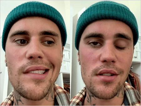 ジャスティン・ビーバーが顔面神経麻痺（ラムゼイ・ハント症候群）発症時の画像