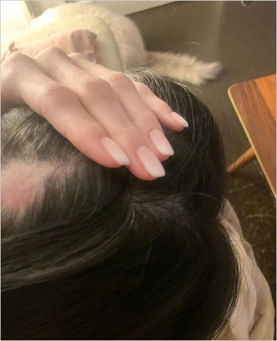 遠野なぎこの円形脱毛症