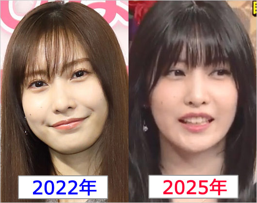 佐野ひなこ整形疑惑、顔比較のビフォーアフター画像