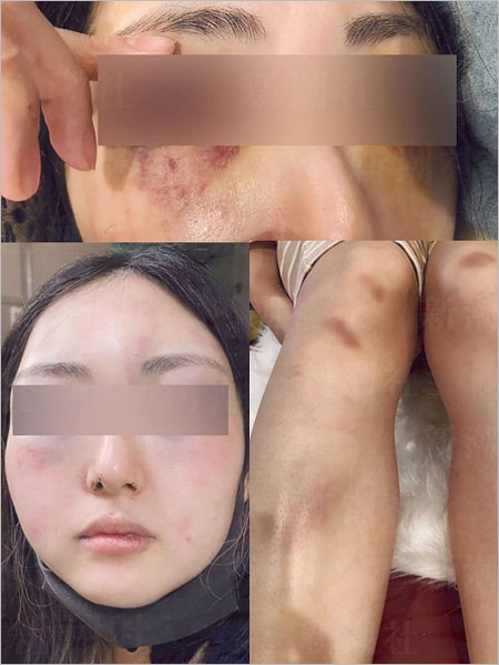 中村児太郎の妻がDV被害後の画像