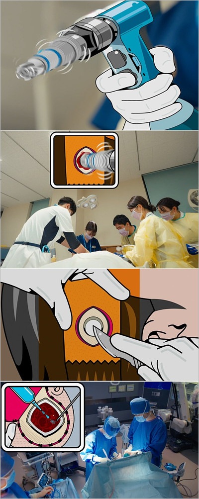 ヤンドク！開頭手術のアニメーション演出