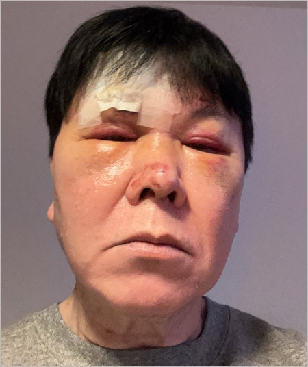 三ツ矢雄二が転倒で大ケガした顔の画像