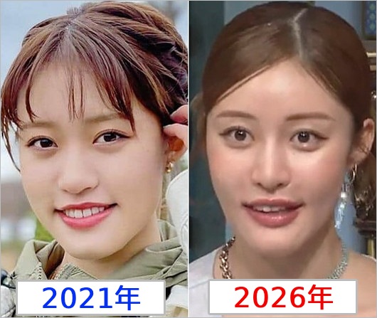 王林が美容整形疑惑、過去と現在の顔比較・検証用画像