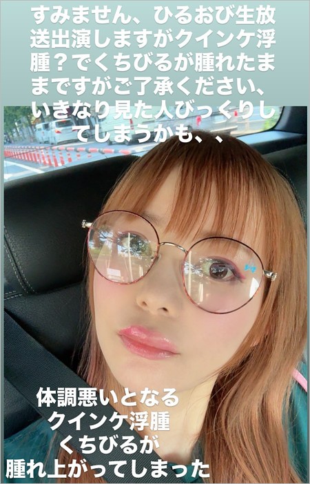 中川翔子がクインケ浮腫で唇が腫れた姿