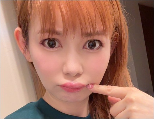 クインケ浮腫発症の中川翔子